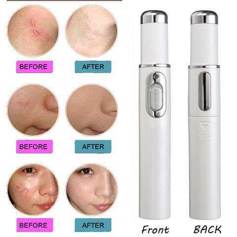 LumiGlow - Acne Laser Pen