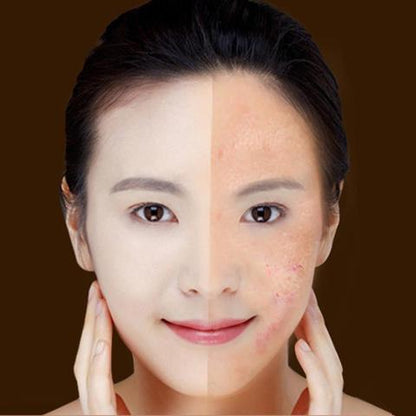 LumiGlow - Acne Laser Pen